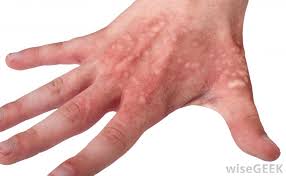 To anyone viewing this, the acetone was burning, by flame, this is not a chemical burn. What Is A Steam Burn With Pictures