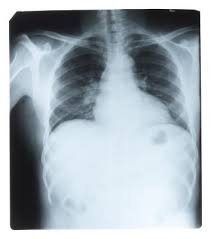 4 Safe Exercises When You Have Fractured Ribs And What To Avoid Livestrong Com Safe Exercises Rib Fracture Bruised Ribs