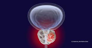 Psa Werte Freies Und Gebundenes Psa Und Andere Prostata Werte Prostata Hilfe Deutschland
