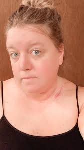 After 5-Years of Remission, Jenn Had 3 Melanoma Recurrences