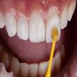 Dental veneers / Hollywood Smile Treatment product image