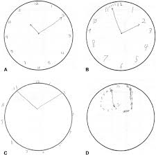 • note the 3 point scoring system. Sample Clock Draw Tests Of Patients With The Following Clock Draw Test Download Scientific Diagram