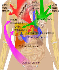 Primary liver cancer occurs most frequently when malignant tumors appear in the liver. Department Of Surgery Liver Metastases