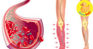 Am pierdut o sarcina prin avort menstrual la 5 saptamani. Ce Este Trombofilia Si De Ce Pare Sa Fie Atat De Populara In Romania Desprecopii Com