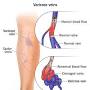 treatment for spider veins from my.clevelandclinic.org