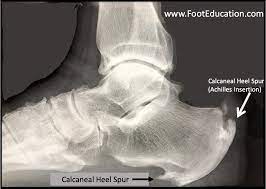 They can come from local trauma to the bone, cartilage or tendon near where a bone spur has formed. Bone Spurs Footeducation