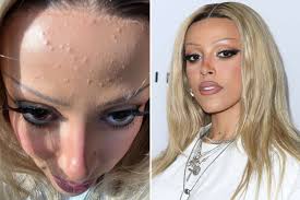 Doja Cat Reveals Forehead Acne in Close-Up Instagram Photo