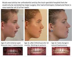 We did not find results for: Falim Or Mastic Gum Mew Straight Teeth Nasal Obstruction