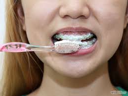 Having stuck floss in your braces is a nightmare. Manassas Va Orthodontists Daczkowski Orthodontics Oral Hygiene