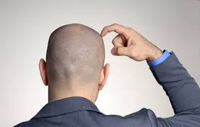 Telogen effluvium does not generally lead to complete baldness, although you may lose 300 to 500 hairs per day, and hair may appear thin, especially at the crown and temples. Going Bald At 20s How To Deal With It New Research 2021 Skull Shaver Euro