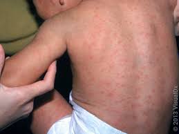 Image result for Rubella