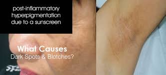 Shining The Light On What Causes Dark Spots Blotches Shine The Light Graves Disease Symptoms Skin