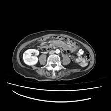 We did not find results for: Colocolic Intussusception Radiology Case Radiopaedia Org