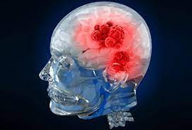 Brain Cancer: Causes, Types, Symptoms, Treatment, Survival Rate