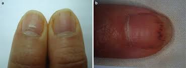 Kidney disease, or renal disease, also known as nephropathy, is damage to or disease of a kidney. Nail Diseases Among Renal Patients Springerlink