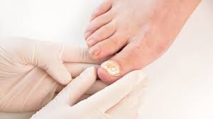 Image result for Pitting nails feet