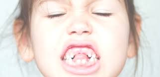 Secara umum, setiap mimpi yang di dalamnya terdapat objek gigi bisa merupakan pertanda baik atau malah sebuah pertanda buruk. Terbaik Mimpi Gigi Ompong