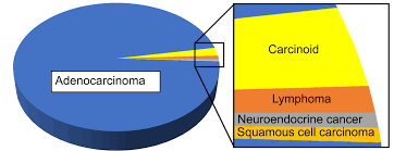 Finding and removing polyps can prevent colorectal cancer. Histopathology Of Colorectal Adenocarcinoma Wikipedia