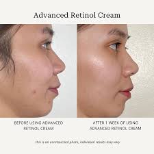 🕰️ One week is just the beginning! To unlock the full potential of our  𝘼𝙙𝙫𝙖𝙣𝙘𝙚𝙙 𝙍𝙚𝙩𝙞𝙣𝙤𝙡 𝘾𝙧𝙚𝙖𝙢, consistency is key. Results may  vary, but amazing transformations come with time. Stay consistent, stay