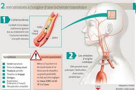 Lors d'un avc, certaines parties du cerveau ne sont plus suffisamment irriguées par le sang. Ces Signes Precurseurs De L Avc