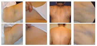 Our expert team uses the latest laser hair removal technology. Men S Laser Hair Removal London