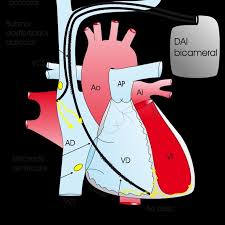 El desfibrilador automático implantable se injerta en la zona pectoral, entre la piel y el músculo (puede molestar algo al levantar el brazo). Desfibrilador Automatico Medicos De Corazon Facebook