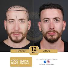 Why Choose Hair Center of Turkey for Hair Transplant?