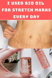 Bio Oil For Stretch Marks Review India You Have A Wedding Of A Close Family Member To Attend Isn T That Exciting You Have A Wedding Of A Close Fa In 2020 Oil For Stretch Marks Stretch Marks