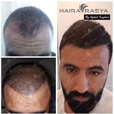 4500 Grafts 8 Months Perfect Result Of Our After The Hair Transplantation