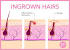 Ingrown Hair Infected