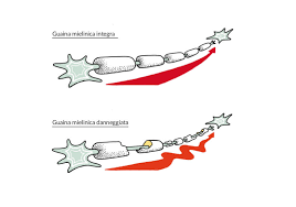 La sclerosi multipla (sm) è una malattia cronica che colpisce il sistema nervoso centrale per cui è neurodegenerativa. Sclerosi Multipla Come Agisce E Possibili Cause Aism Associazione Italiana Sclerosi Multipla