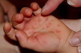 Members include polioviruses, coxsackie a virus, coxsackie b virus, echoviruses, and the numbered enteroviruses. Bila Mak Ayah Risau Anak Kena Penyakit Hfmd Almaricantik
