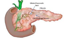 Cystic fibrosis, also known as mucoviscidosis, is an autosomal recessive genetic disorder that affects most critically the lungs, and also the pancreas, liver, and intestine. Introduction To Pancreatic Disease Chronic Pancreatitis Pancreapedia
