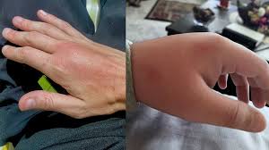 Image result for mosquito bite
