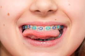 Contact your insurance provider to know how much cost they will cover for braces and then visit a few dentists and decide on who you want to go ahead with. Braces For Kids How Much Do Braces Cost For Kids