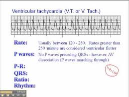 Jason winter @ ecg educator download the ventricular tachycardia template to learn ventricular tachycardia (vtach) | circulatory system and disease. Ecg Ventricular Tachycardia Vt Youtube
