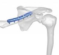 Clavicle Plating System | Acumed