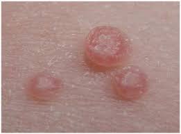 Bumps on penile shaft not std. Prevalence And Motivation Pubic Hair Grooming Among Men In The United States Abstract Europe Pmc