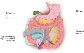 The angle of the duodenojejunal flexure expands by contraction of this. Retroperitoneal Node Dissection Oncohema Key