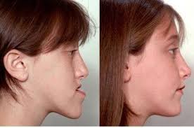Does the numbness of a low jaw surgery ever completely go away?