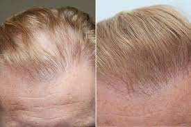 This famous treatment delivers platelet rich plasma (prp) using the microneedling technique. Vampire Hairlift Is Bloody Newfangled Treatment Balding Brits Are Counting On But Does It Work Mirror Online