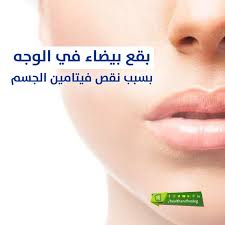 بقع بيضاء في الوجه بسبب نقص فيتامين الجسم