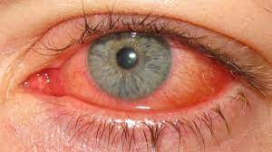 Goz Sismesi Goz Kapagi Sismesi Neden Olur Bilgi Deryasi Sunburn Symptoms Natural Remedies For Sunburn Home Remedies For Sunburn