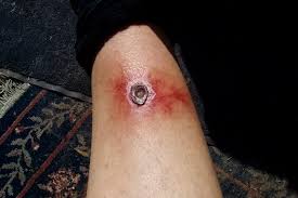 Image result for wolf spider bite skin