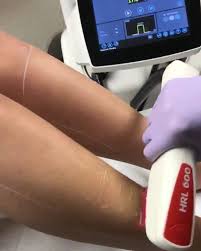 In this buyer guide you will find all information you need to take your decision. Nordlys By Candela Ellipse Ipl Hair Removal Treatment Facebook