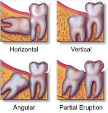 Wisdom teeth typically emerge between the late in most cases, wisdom teeth are removed before they erupt. How Much Does A Wisdom Tooth Extraction Cost