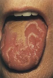 Image result for brown tongue symptoms