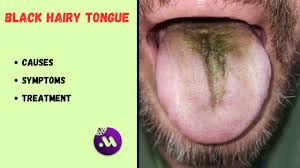 Image result for black tongue symptoms