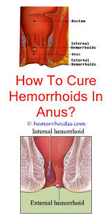 Pin On Hemorrhoid Surgery