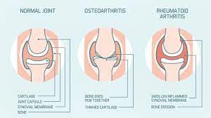 Osteoarthritis is the most common form of arthritis, affecting millions of people worldwide. Rheumatoid Arthritis Vs Osteoarthritis Everyday Health